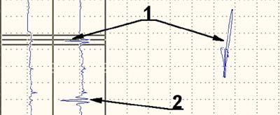 Отображение сигнала вращающегося ВТП от дефектов под головкой заклепки и обшивкой толщиной 2 мм и от дефектов типа трещина, глубиной 0,3 мм (1) и 0,5 мм (2) в барабане авиационного колеса
